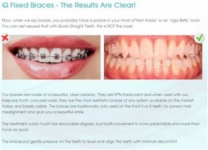 clear fixed braces