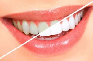 Why Teeth Whitening Is Popular for Dentists