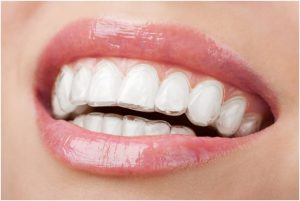 Keeping your Invisalign Braces Clean