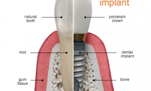 dental implants in cardiff