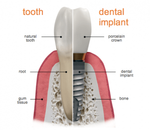 How Long Will My Dental Implants Last?