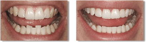 inman aligner before and after