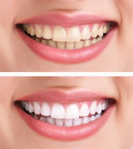 Does Teeth Whitening Remove Stains?