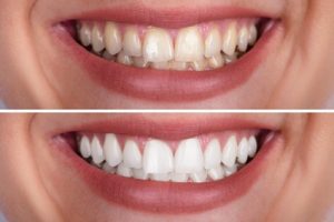 tooth whitening cardiff