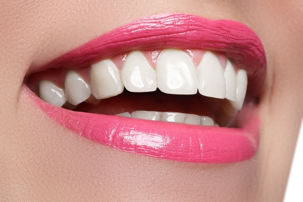 composite veneers