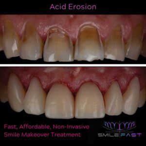 SmileFast Acid Erosion