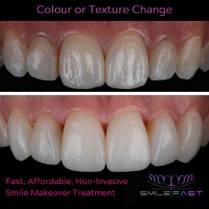 SmileFast Colour change