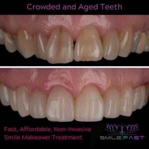 SmileFast Overlapped Crowded teeth