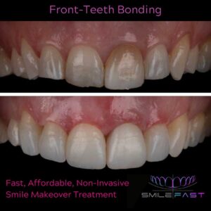 SmileFast Front teeth bonding