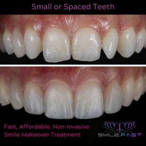 SmileFast Small spaced teeth