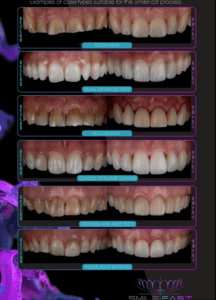 SmileFast Process