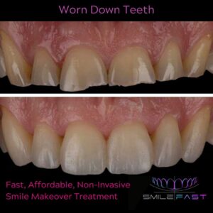 SmileFast Worn teeth