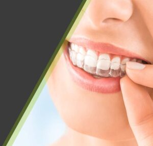 clear braces invisalign cardiff