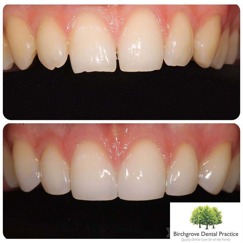 smile makeover treatment cardiff