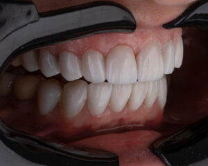 Can You Have Composite Bonding On Crooked Teeth?