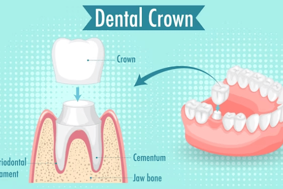 Crowns