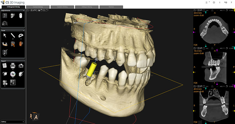 dental implant scan