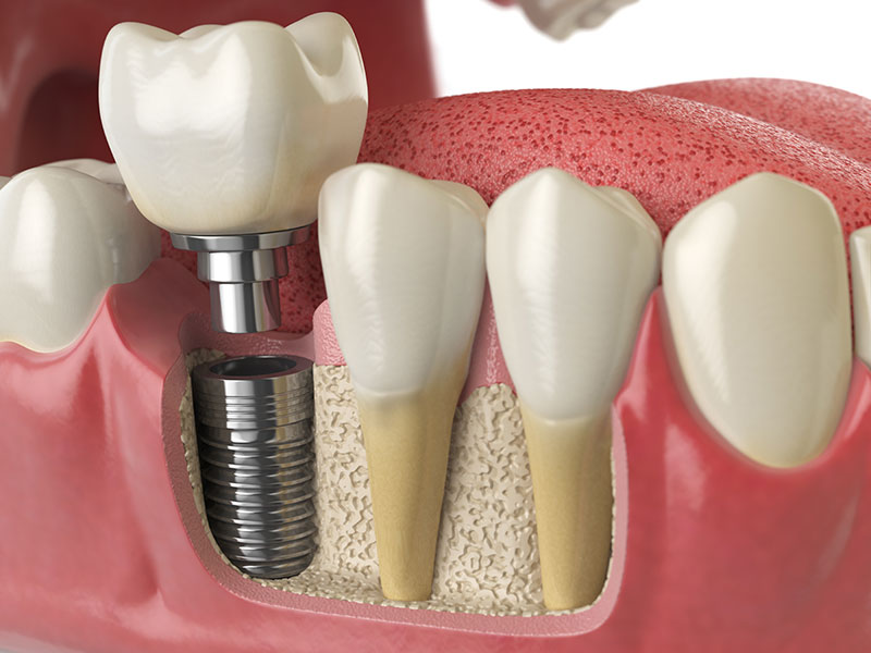 dental implants in cardiff