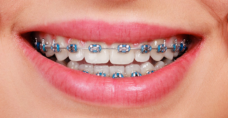 metal braces