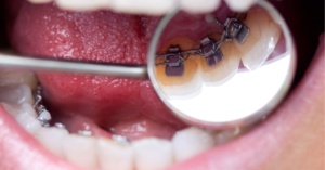 Can Lingual Braces Fix an Overbite?