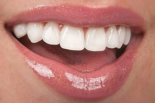 veneers south wales