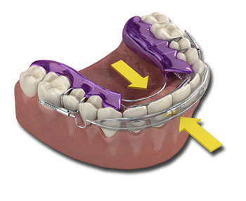 inman aligner 22