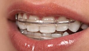 inman aligner