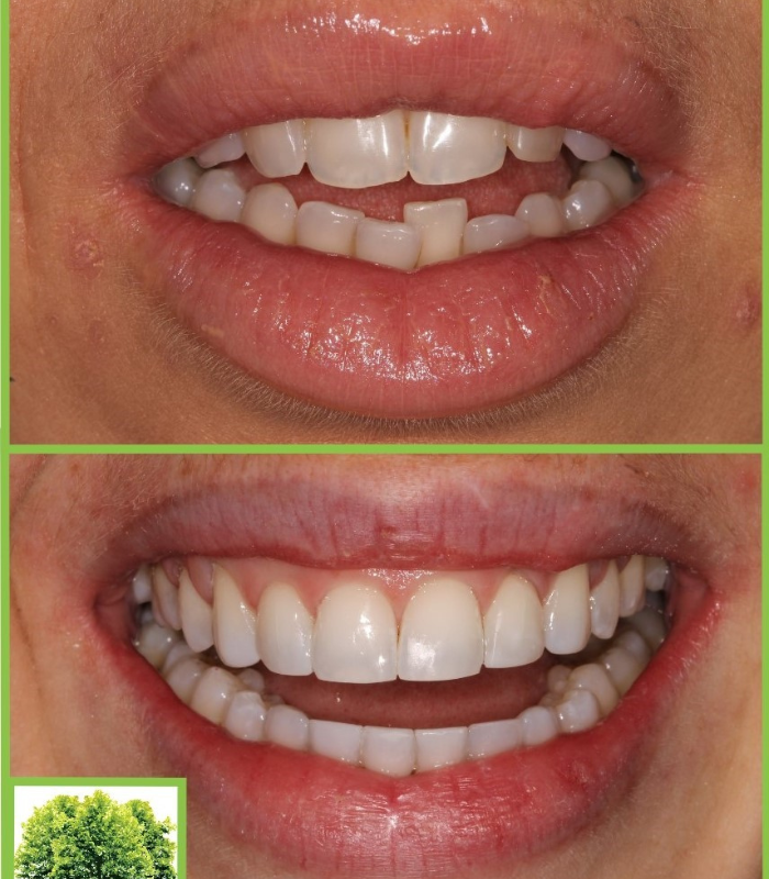 6 month smiles treatment