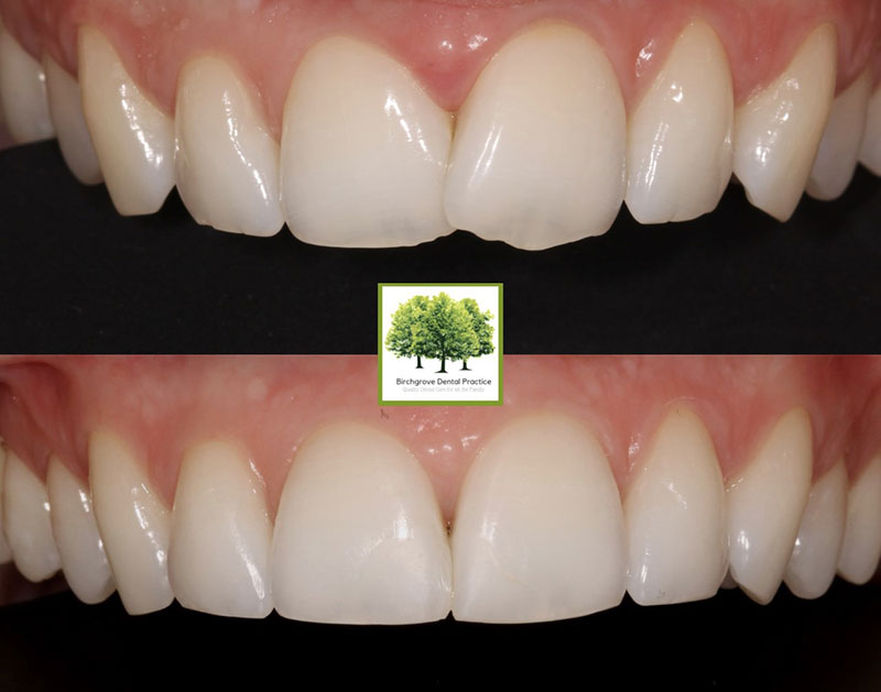 teeth straightening in cardiff