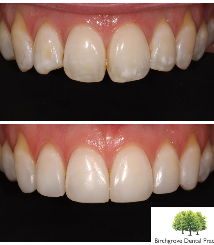 teeth straightening treatment