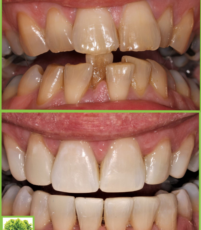 teeth straightening treatments