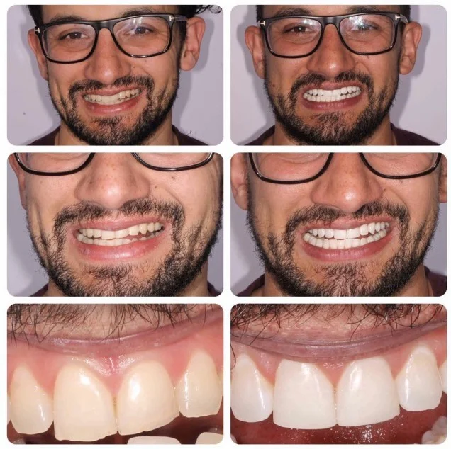 Birchgrove Dental Practice composite bonding Cardiff