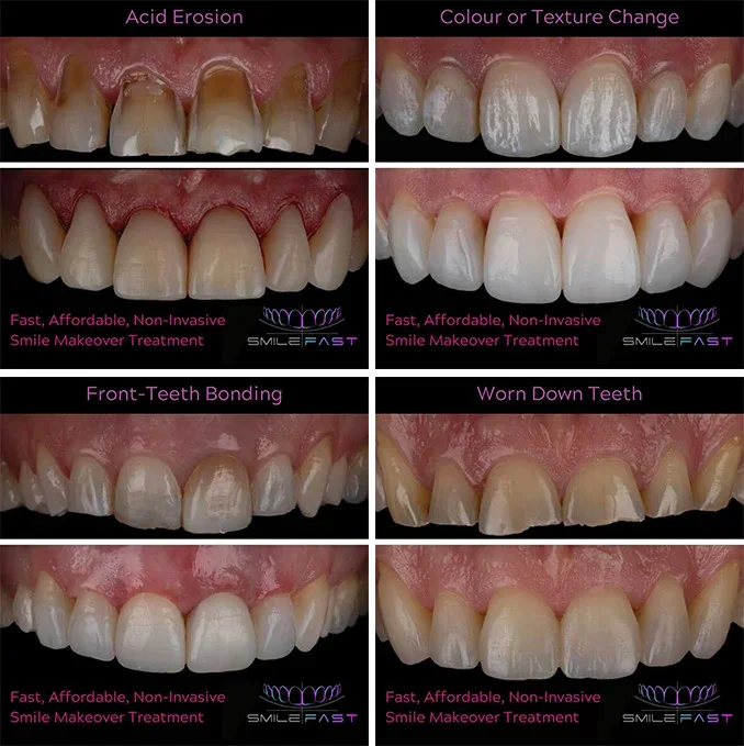 Composite Bonding