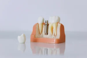 What to Expect During the Dental Implant Process