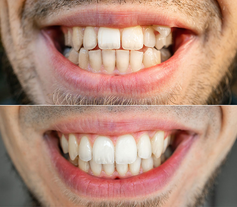 birchgrove dental teeth straightening