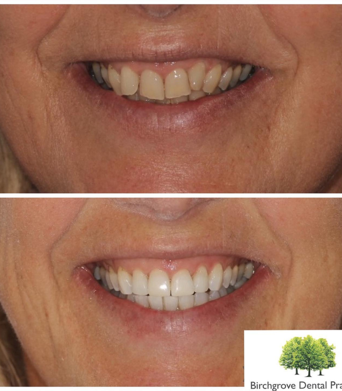 cardiff teeth straightening treatments