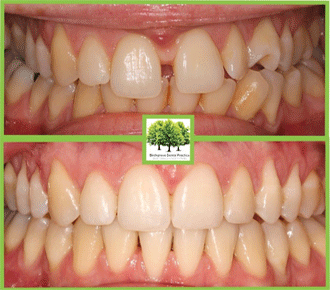 teeth straightening cardiff results