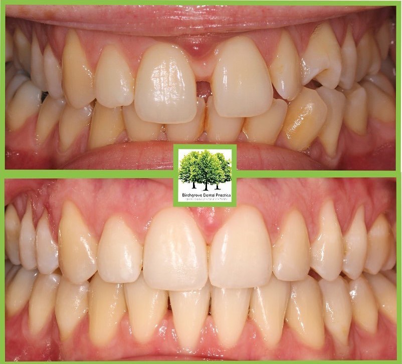 6 month smiles results