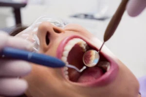 What is a Dental Filling?