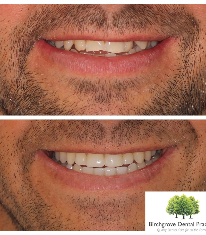 fixed metal braces treatment