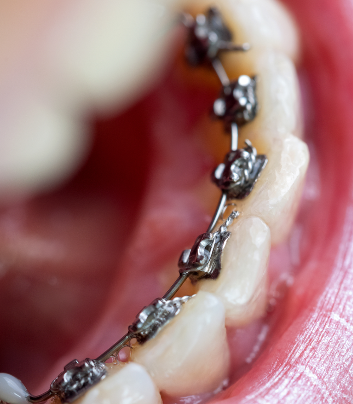 lingual braces south wales