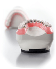 lingual braces treatment