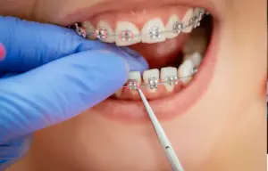 What Colour Braces are Best for Yellow Teeth?