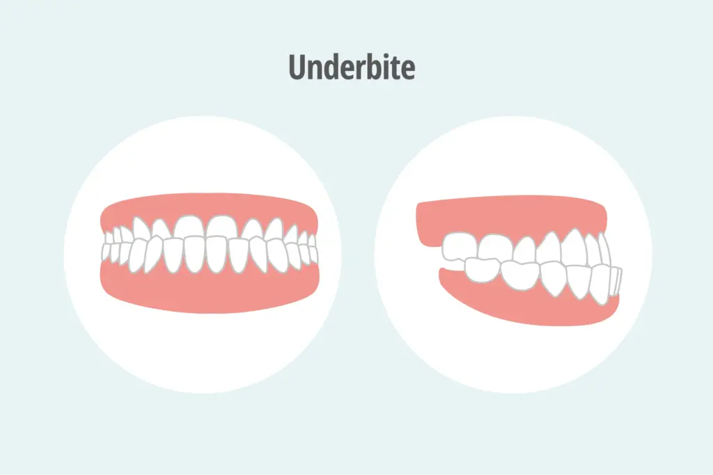 fixing an underbite uk