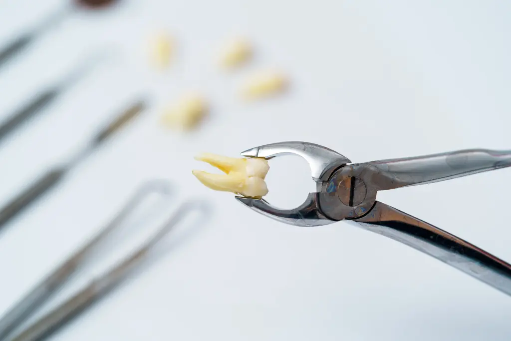 the costs of tooth extraction